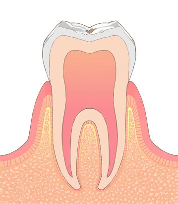 虫歯初期