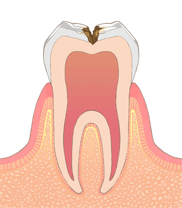虫歯中度
